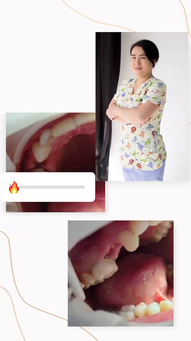 Виниры и коронки