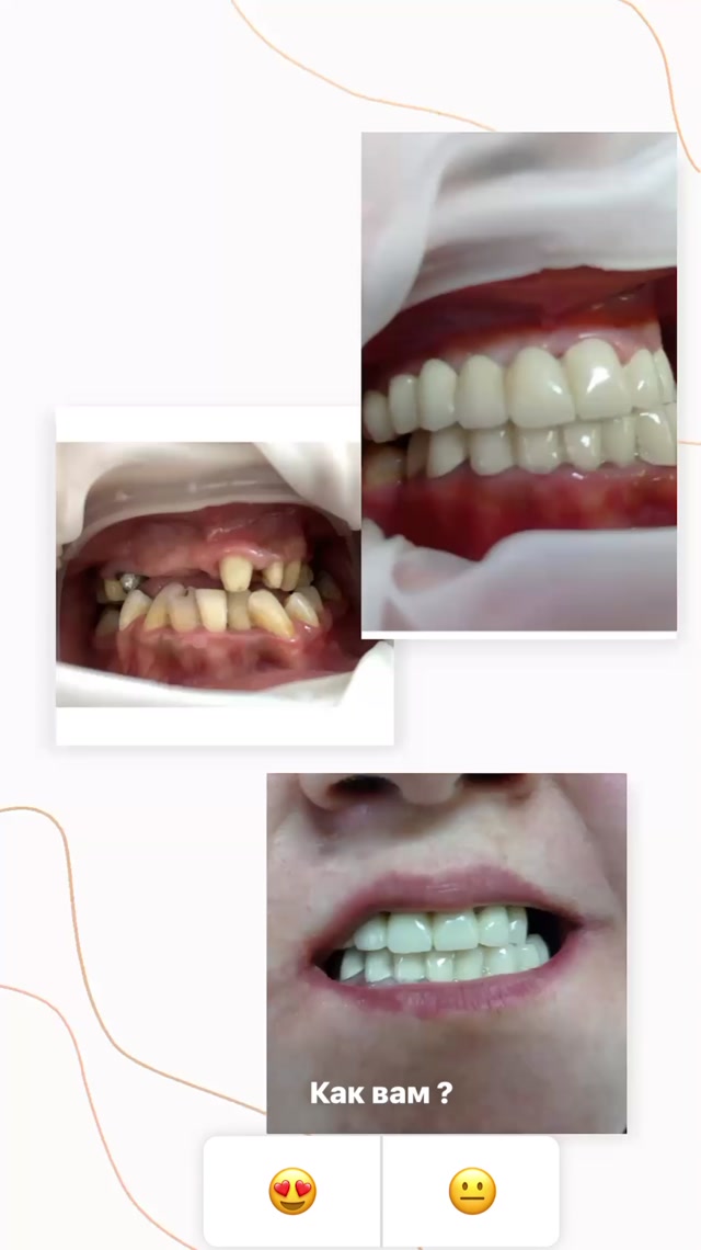 Профессиональная чистка