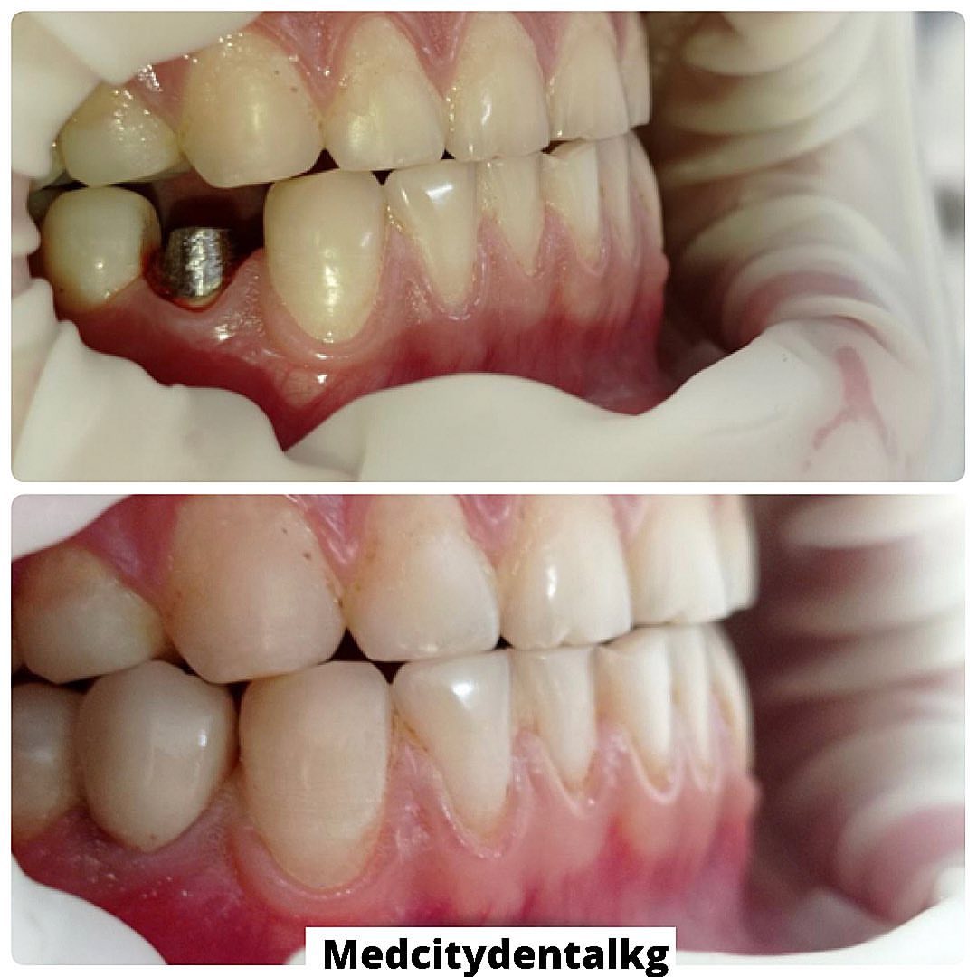 Лечение зубов